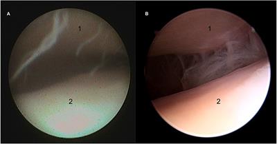 The Equine Temporomandibular Joint: Comparisons Between Standard and Needle Arthroscopic Examination of Cadaver Specimens and Standing Horses